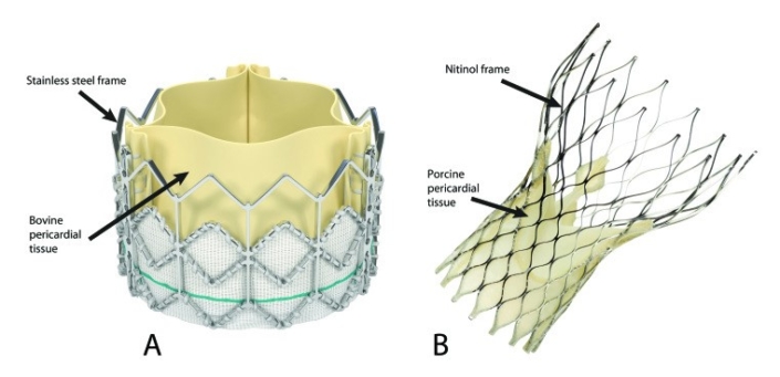 Transcatheter Aortic Valve Replacement In Minneapolis Mn Mhvi